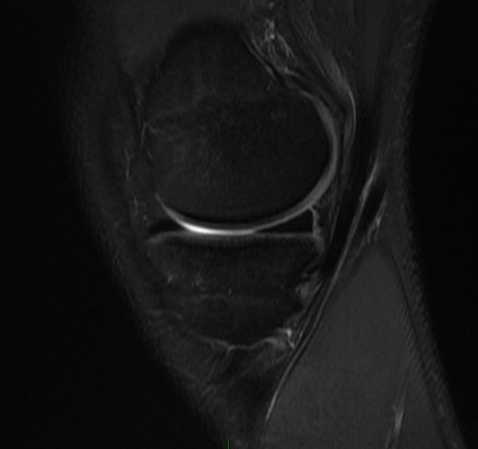Figure 4 for case Capsular attachmet tear